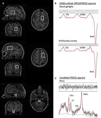 Beyond Dopamine: GABA, Glutamate, and the Axial Symptoms of Parkinson Disease